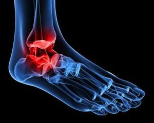 Artrose de tornozelo