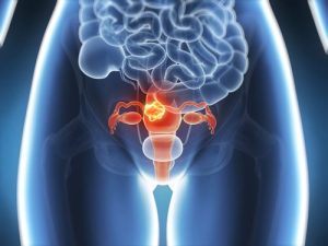 Câncer no colo uterino